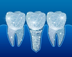 Плюсы и минусы имплантации зубов